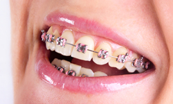 Types of Braces - Zuccala Orthodontics